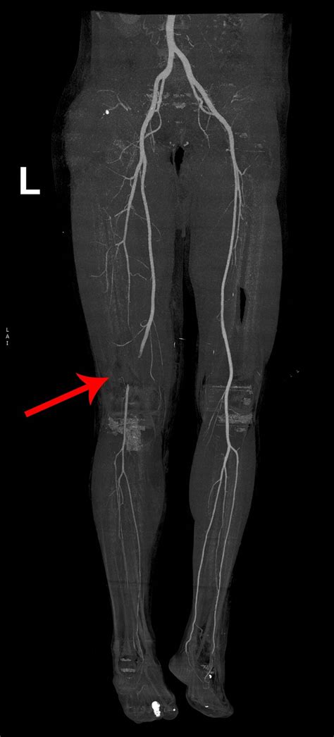 popliteal artery pain